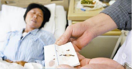 通過手術取出的針?！　∩虉笥浾?