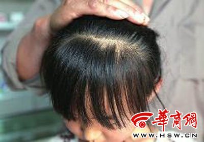 　8歲的嘟嘟在爺爺懷中顯得特別害怕，3個月前被老師揪掉的頭發(fā)至今沒有長出 本報記者 趙釗 攝