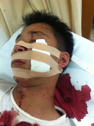 加多寶與廣藥再爆流血沖突 廣藥一員工慘遭毀容 加多寶與廣藥再爆流血沖突 廣藥一員工慘遭毀容