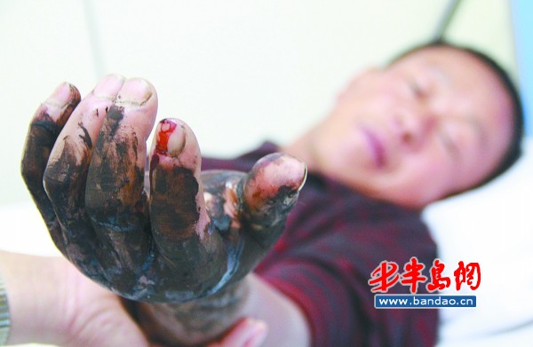 鄒先生的左手被蛇咬傷后明顯腫脹。