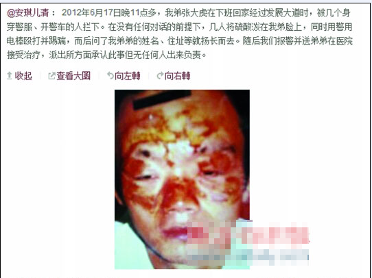 張大虎的姐姐將弟弟面部燒傷一事發(fā)上微博，引發(fā)網(wǎng)友廣泛關(guān)注。
